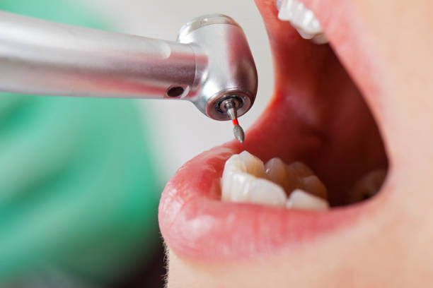 Best Same-Day Emergency Dentist in Homeland, CA